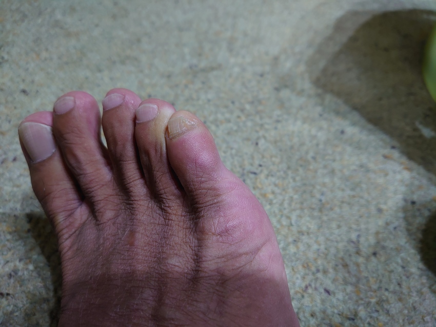 正常な右足の小指