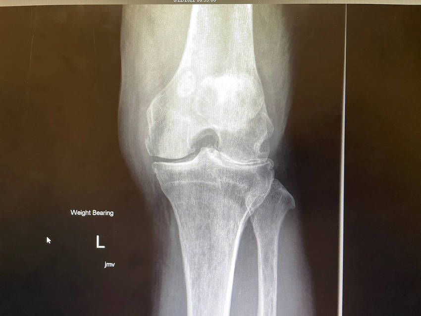 My Left Knee X-Ray ... arthritis...